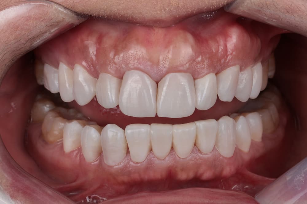 patient with ultrathineers
